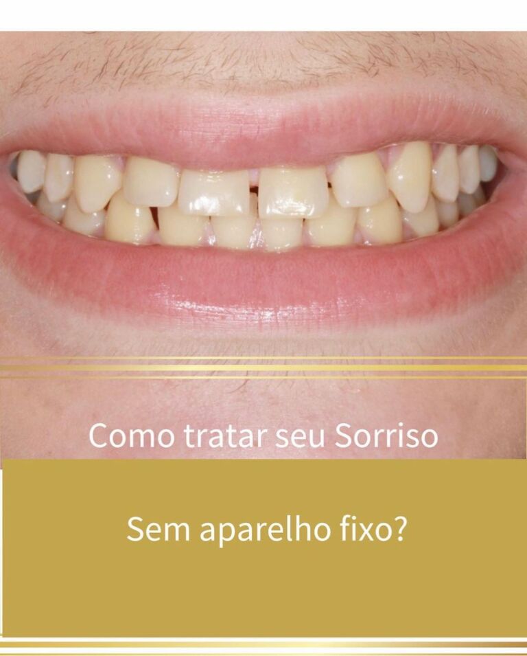 Como Tratar Seu Sorriso Sem Aparelho Fixo - SouRiso - Dra. Silvia Faria ...