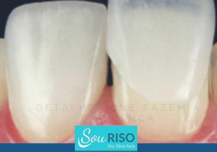 Lente de contato dental desenvolve estética do sorriso